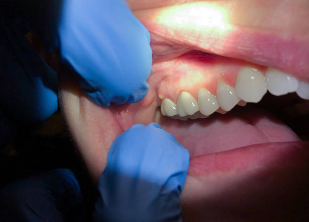 Best Emergency Tooth Extraction  in Twin Grove, IL
